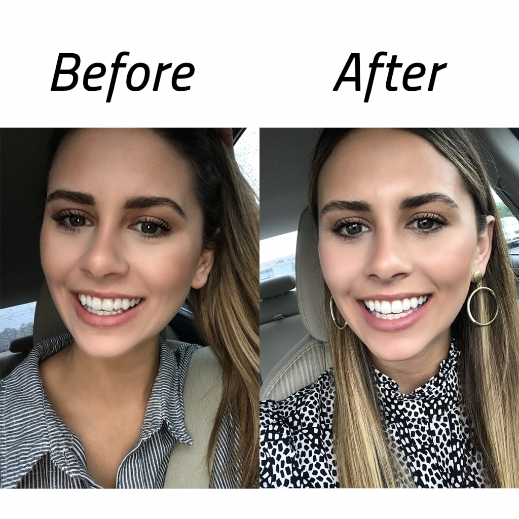 Invisalign Bride A Wedding-Ready Smile by Invisalign® - Westrock Orthodontics