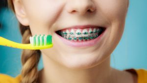 How Do You Brush Your Teeth with Braces?
